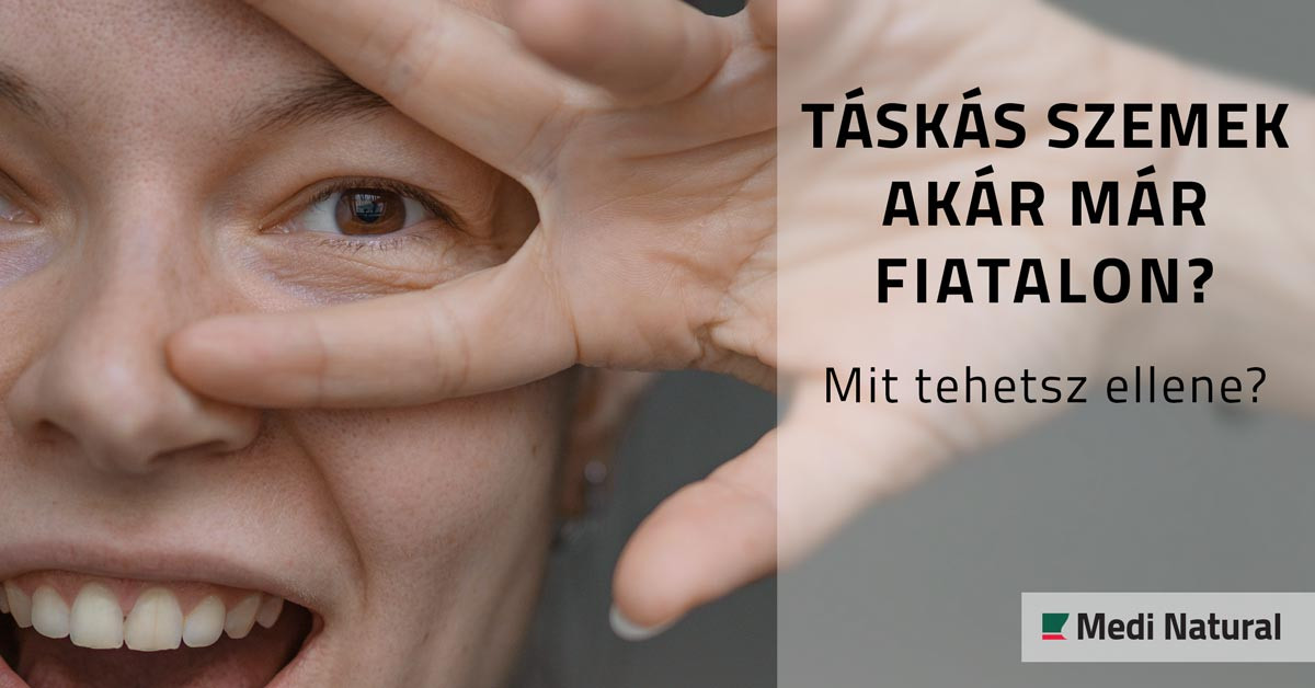 Táskás szemek akár már fiatalon? Mit tehetsz ellene?