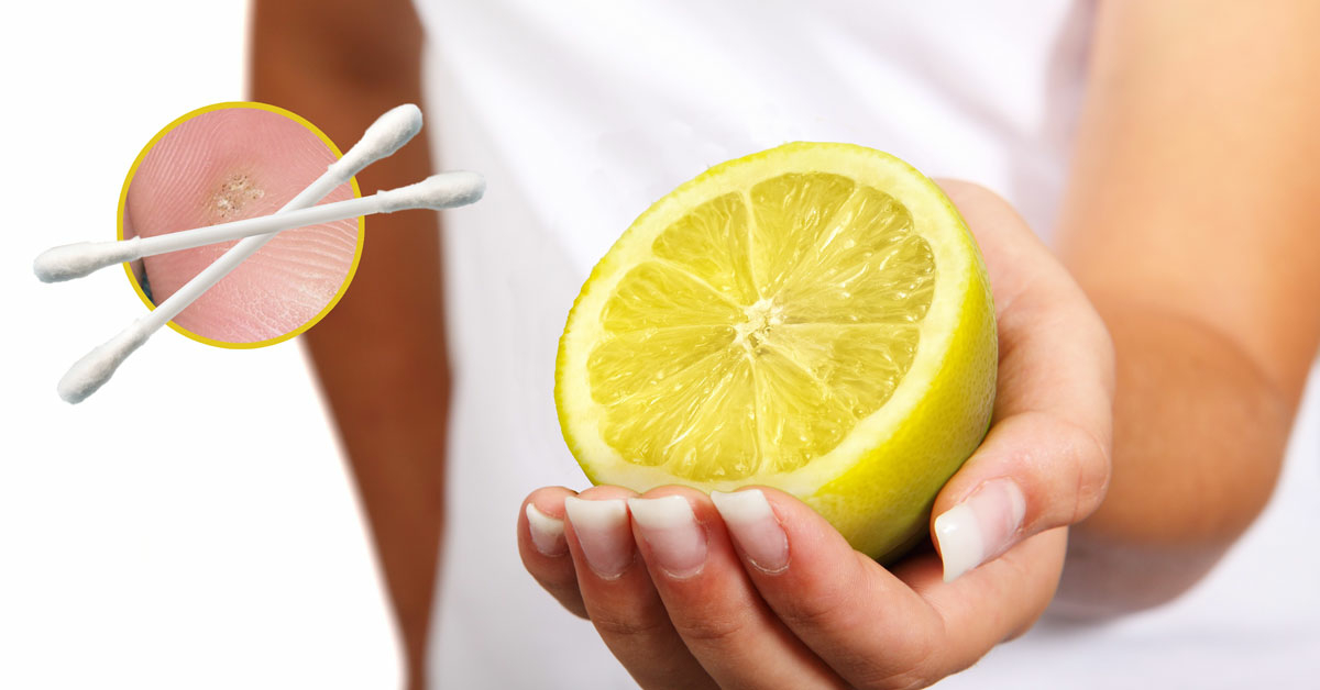 kezelés szemölcsök citrommal
