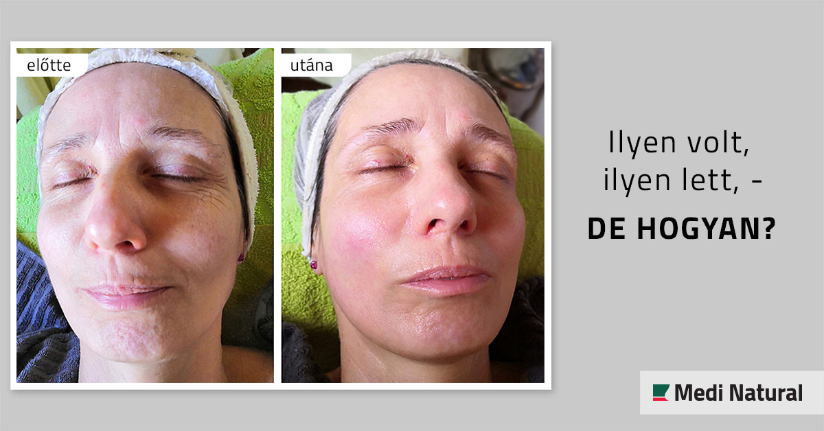 Ilyen volt, ilyen lett, - de hogyan? Ránctalanítás