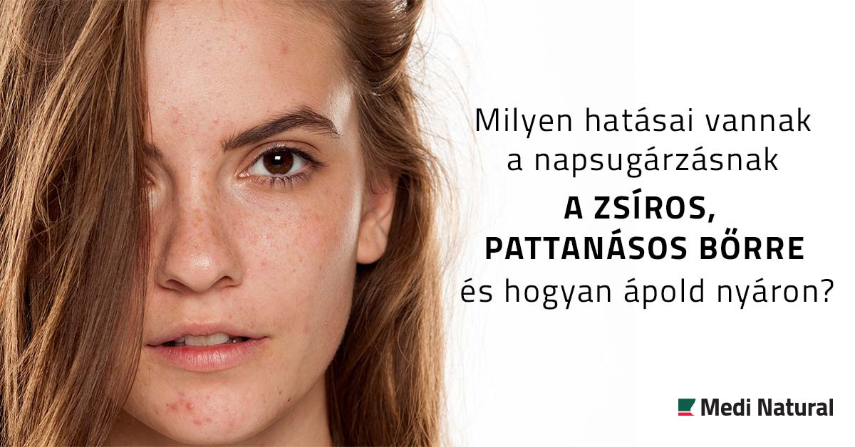 Milyen hatásai vannak a napsugárzásnak a zsíros, pattanásos bőrre és hogyan ápold nyáron?