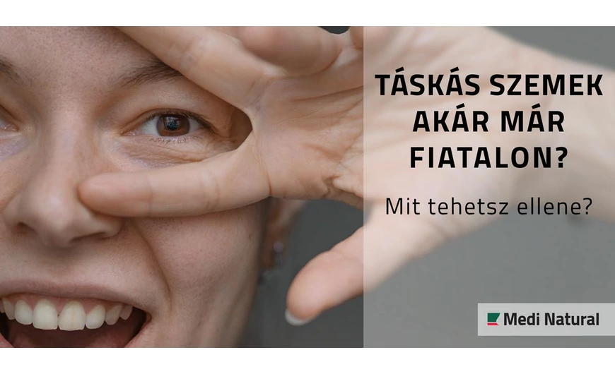 Táskás szemek akár már fiatalon? Mit tehetsz ellene?