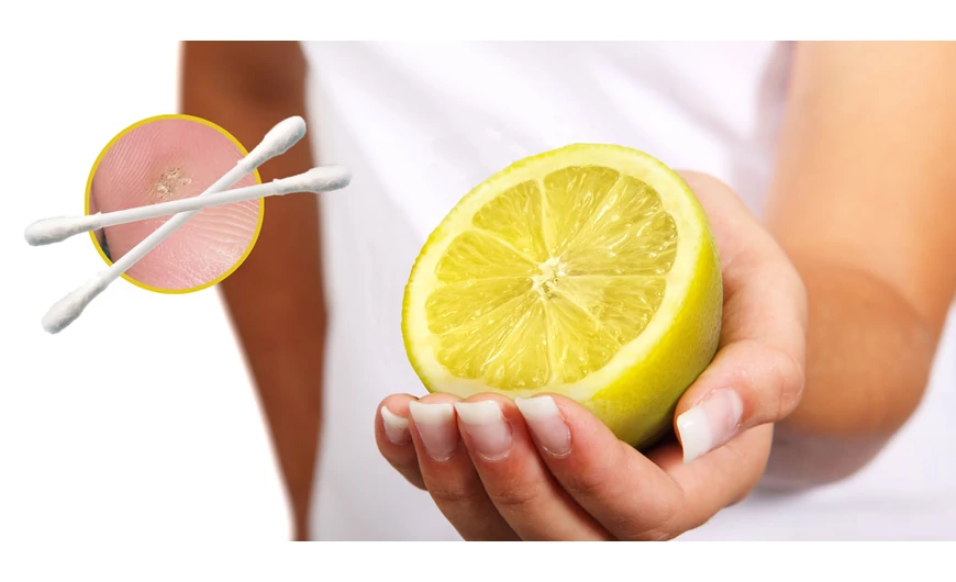 Természetes megoldás szemölcs ellen