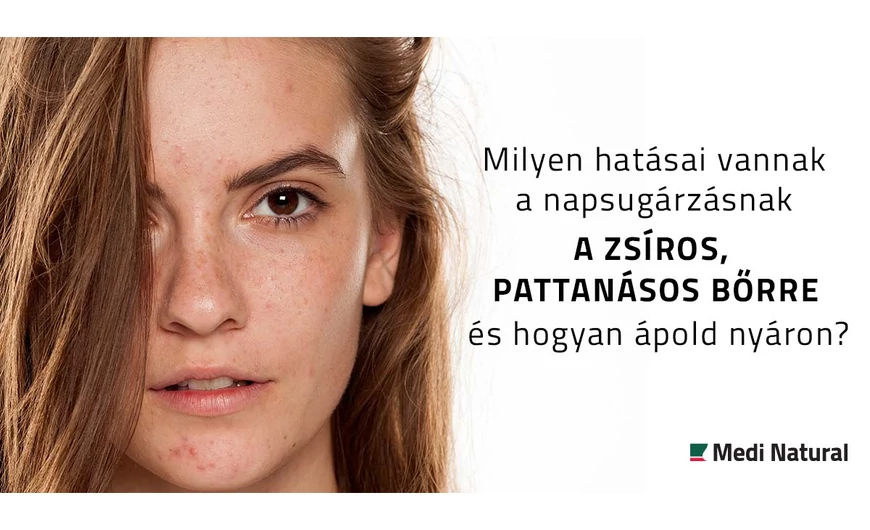 Milyen hatásai vannak a napsugárzásnak a zsíros, pattanásos bőrre és hogyan ápold nyáron?