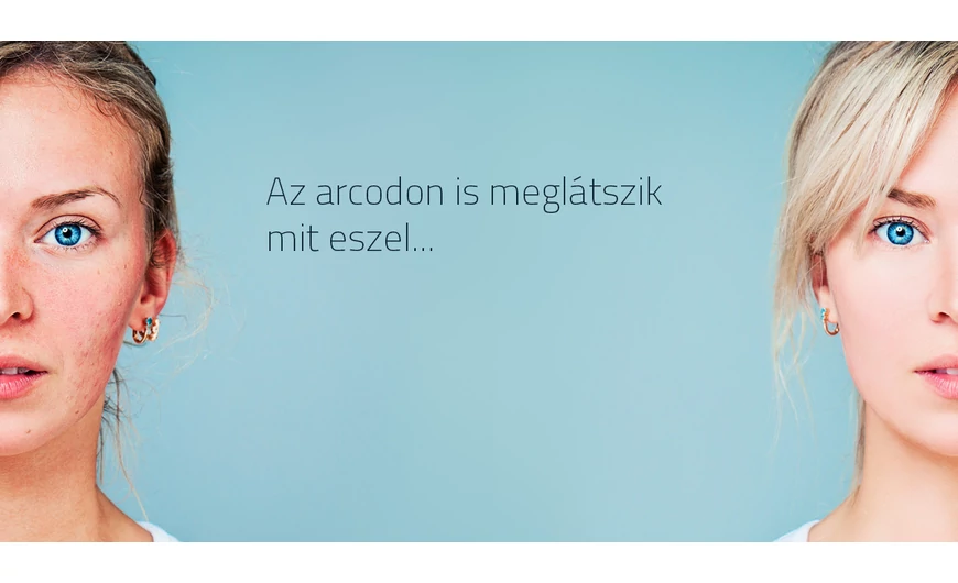 Az arcodon is meglátszik mit eszel, avagy hogyan tüntessük el a pattanásokat