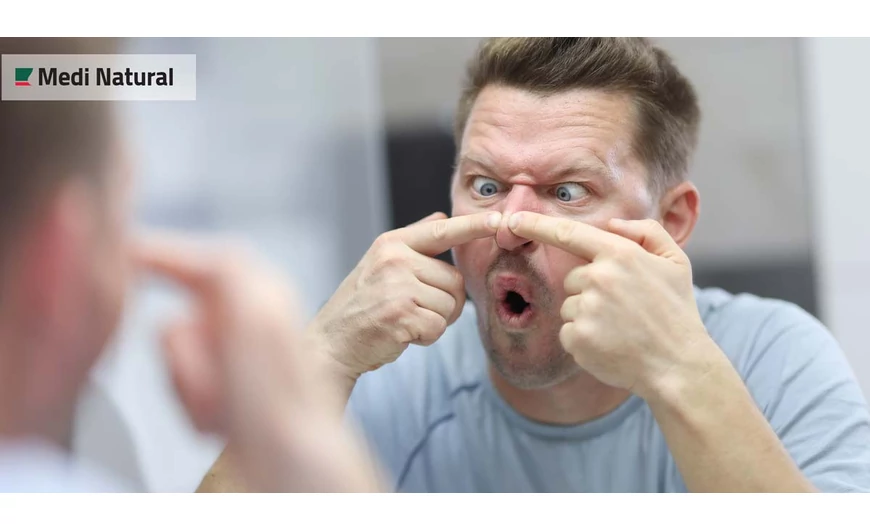 ​A pattanások lehetséges okai – és tippek az elkerülésükre