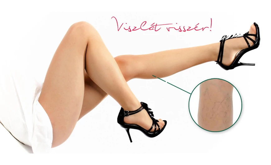 Viszlát visszér - 3 hatásos házi gyógymód visszér ellen