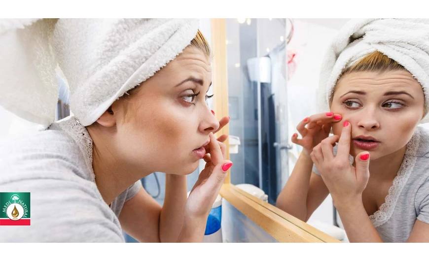 A zsíros bőr segélykiáltása – halld meg és tégy ellene!